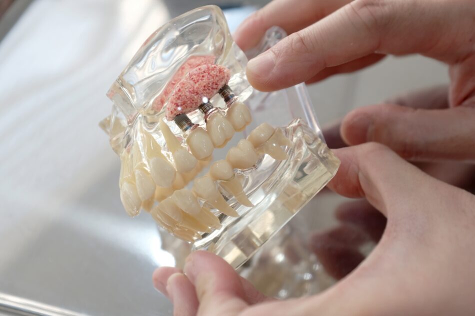 Dental Implants Little Rock